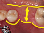 Resorption osseuse post-extractionnelle