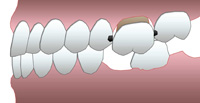 Ouverture des points de contact entrainant des caries